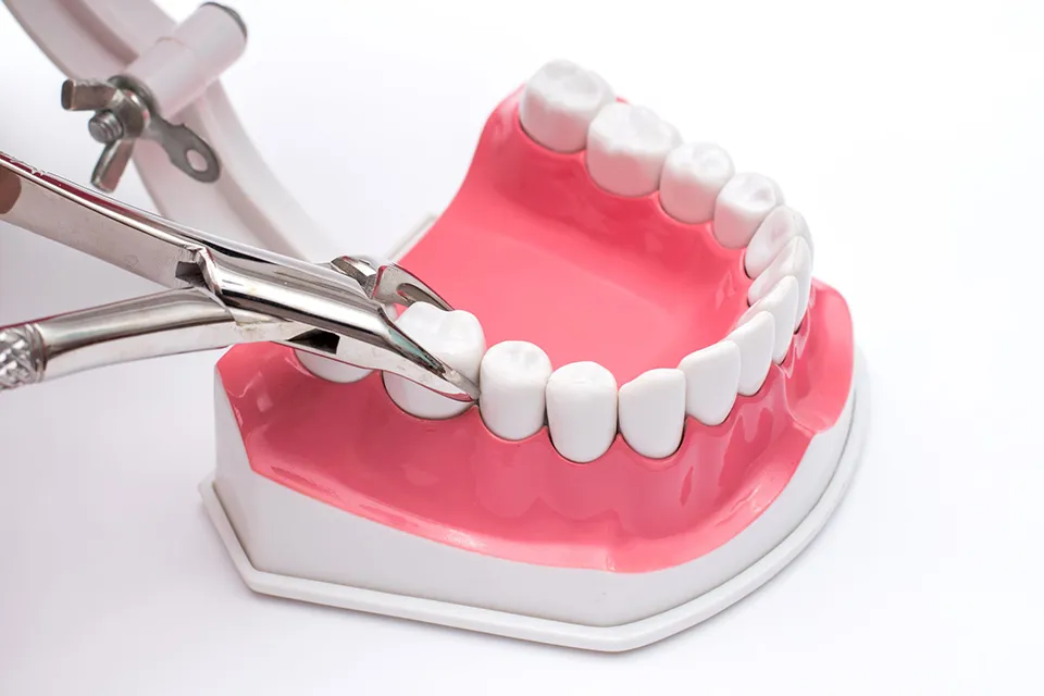 Types Of Tooth Extractions Overview And Procedures