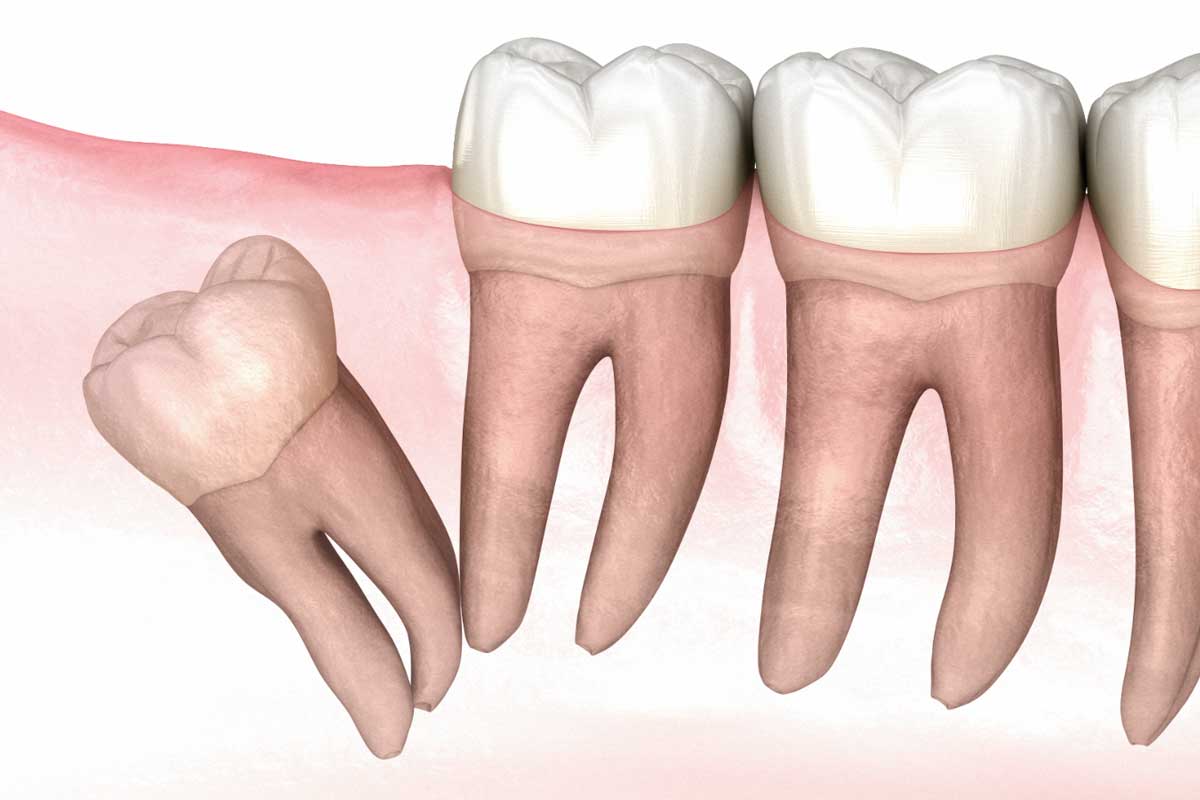 Affordable Wisdom Tooth Removal in Thornhill, Toronto