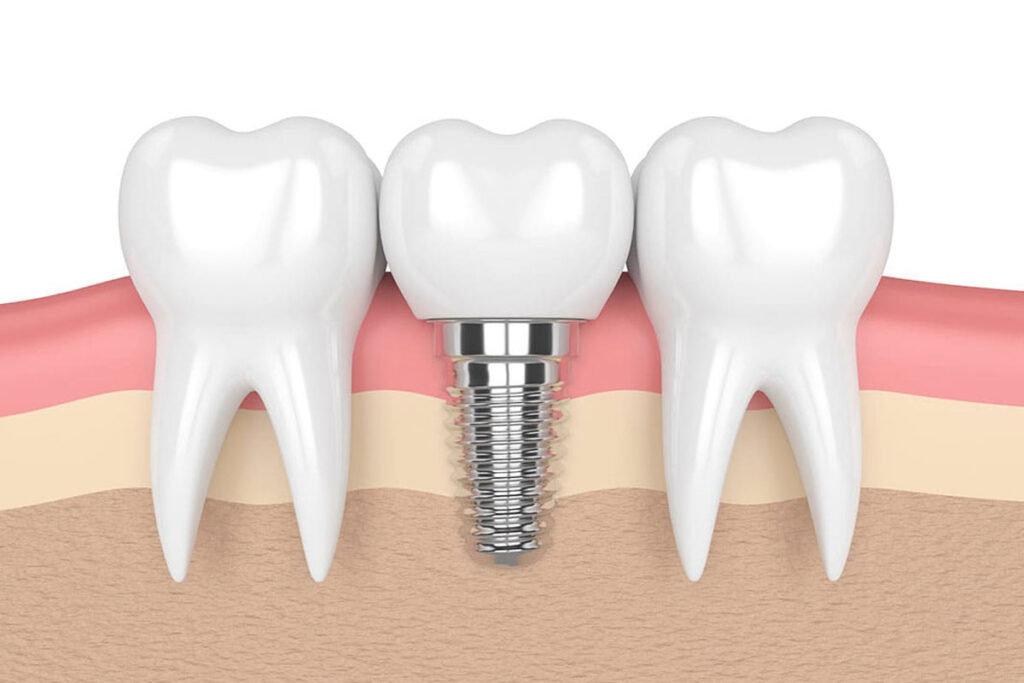 Tips for Keeping Your Implants in Good Condition by SkyRise Dental in Thornhill