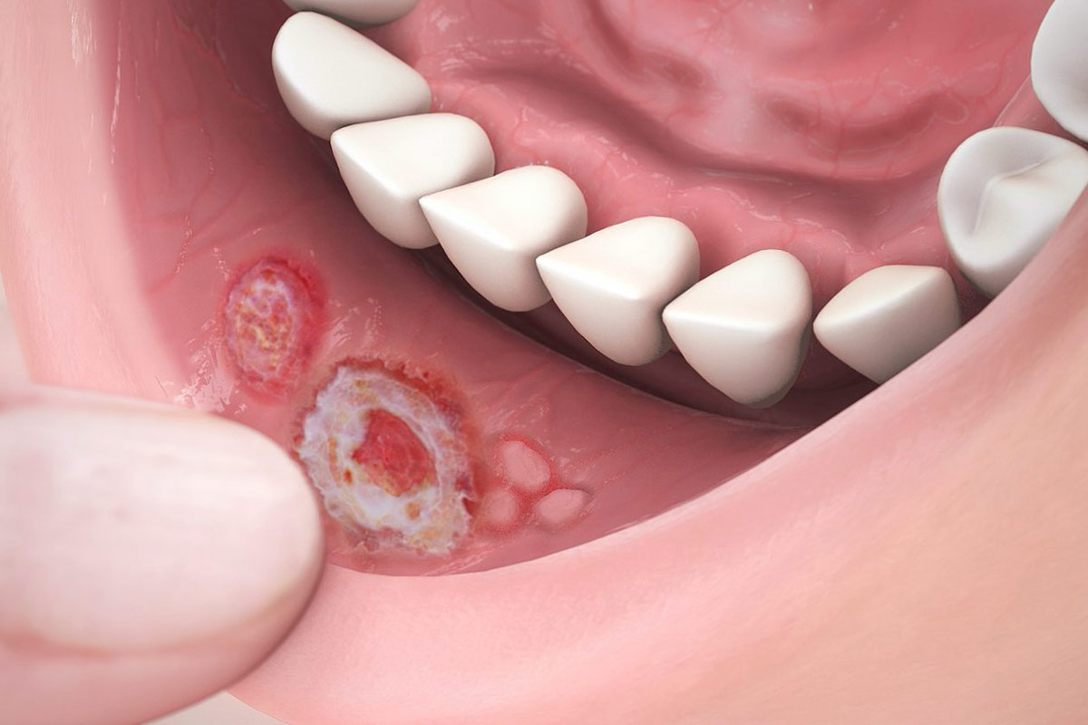 Strategies for Treating and Preventing Canker Sores