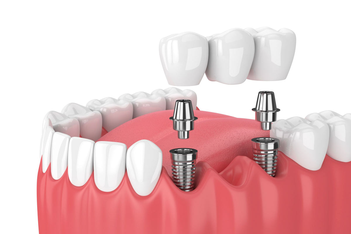 Dental Implants Over Traditional Dentures in Thornhill, Ontario