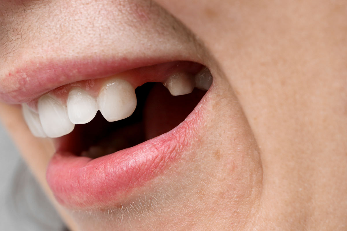 Tooth Extraction in Thornhill, Ontario