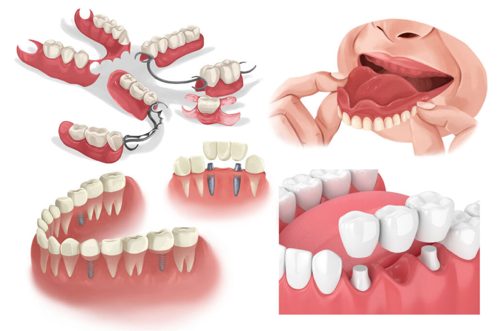 Tooth Replacement Options: A Comparison of Dental Implants