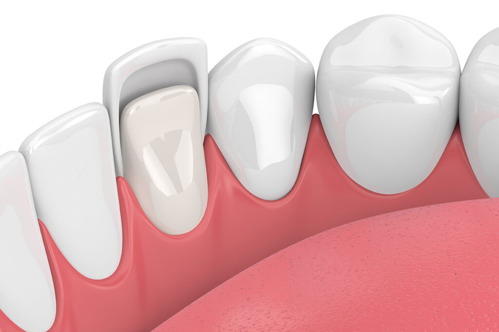 Affordable Dental Veneers in Richmond Hill, Ontario