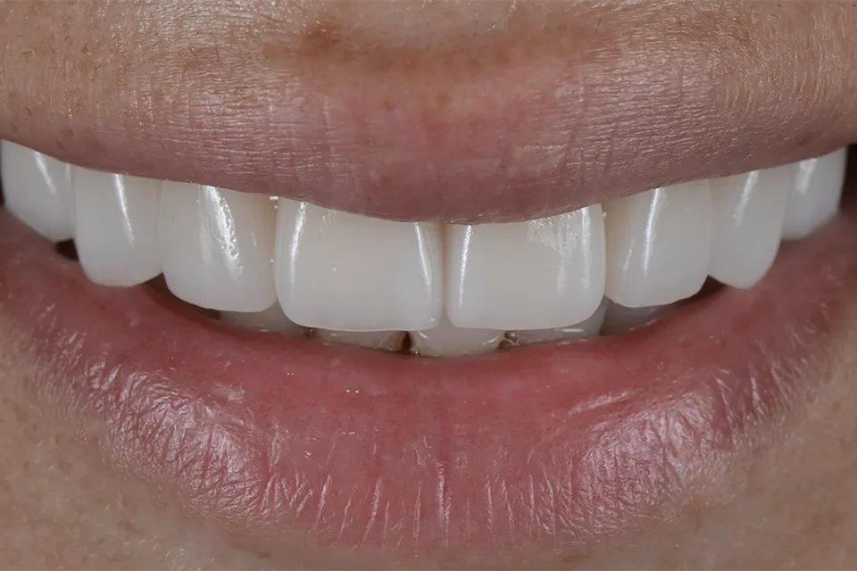 Dental Bonding For Front Teeth : How Does It Work?