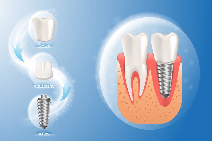 What Is a Dental Implant