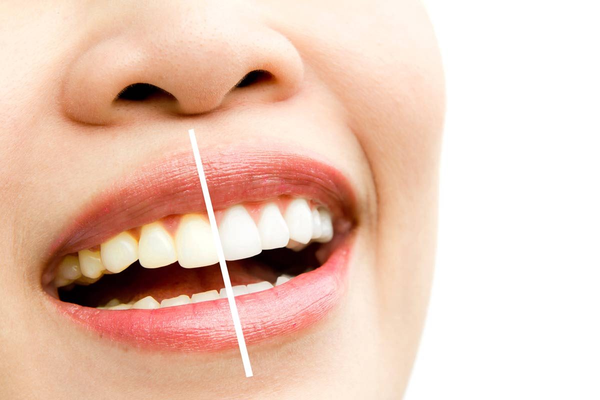 Best Teeth Whitening in Thornhill, Toronto