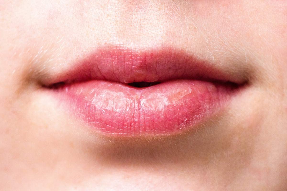 Halitosis Best Halitosis Treatment in Thornhill, Toronto