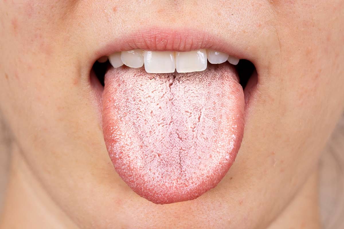 The Best Advantages of Tongue Scraping Explained By SkyRise Dental In Thornhill