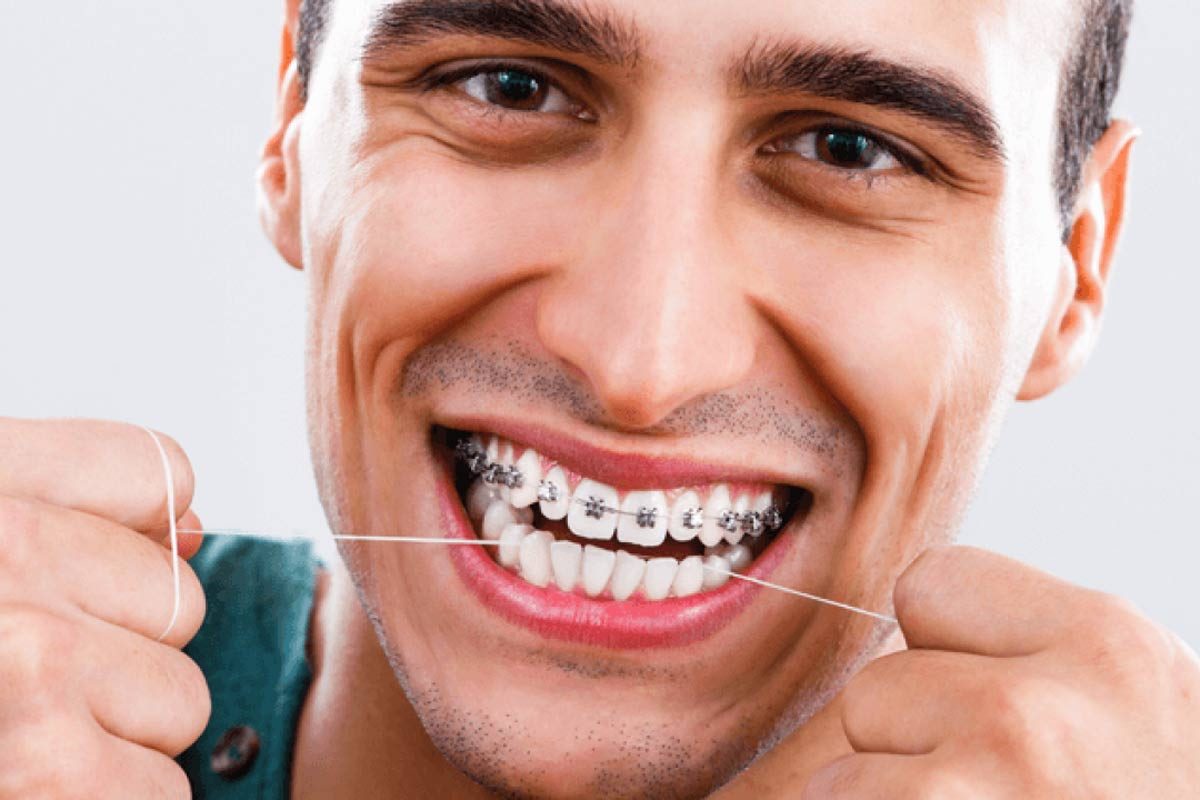 Flossing with Braces Maintaining Excellent Oral Hygiene While Wearing Braces