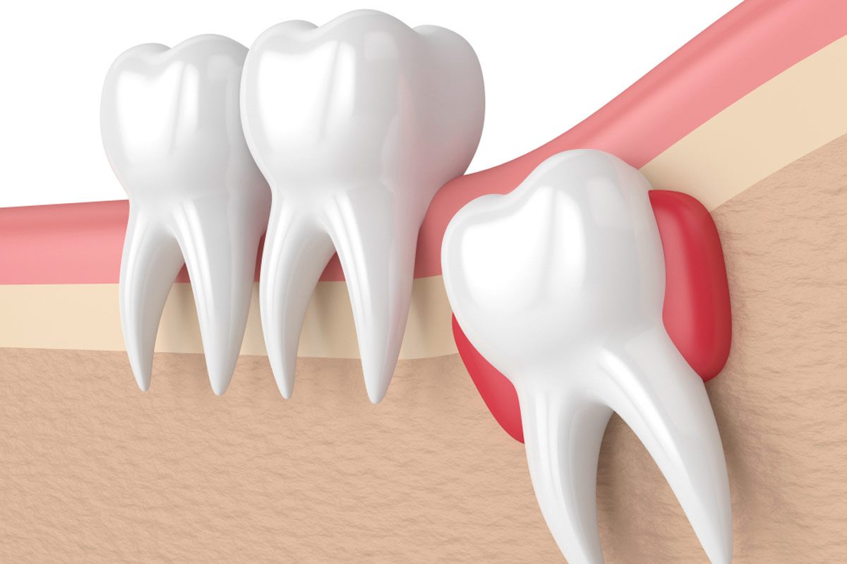 Wisdom Teeth The Importance of Regular Dental Examinations for Wisdom Teeth
