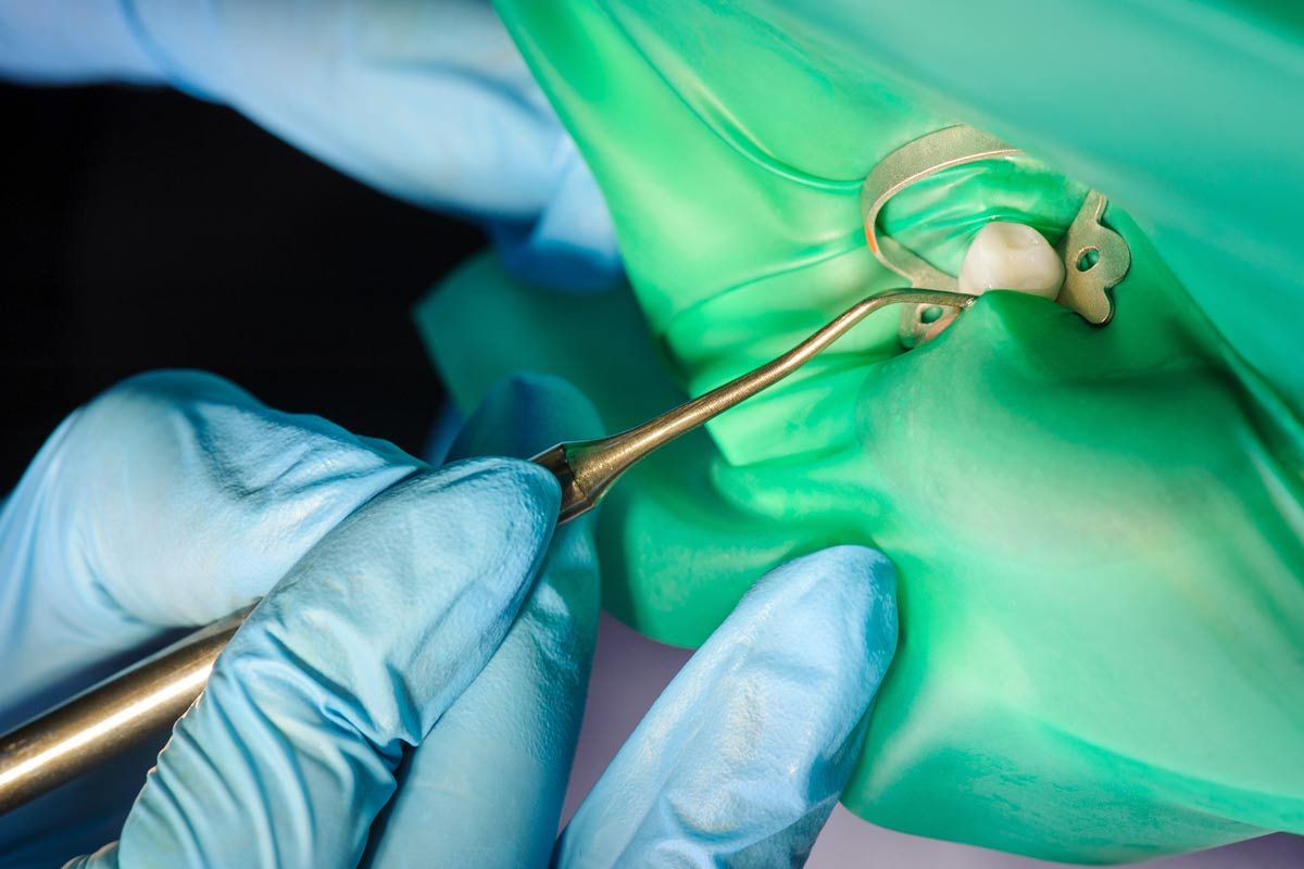 The Tooth Extraction Process