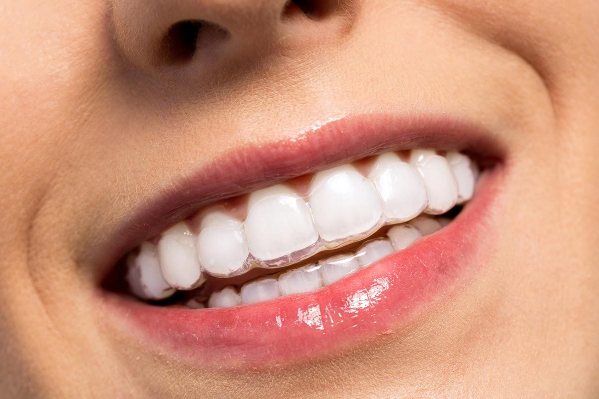 Invisalign Treatment: The Clear Path to a Perfect Smile