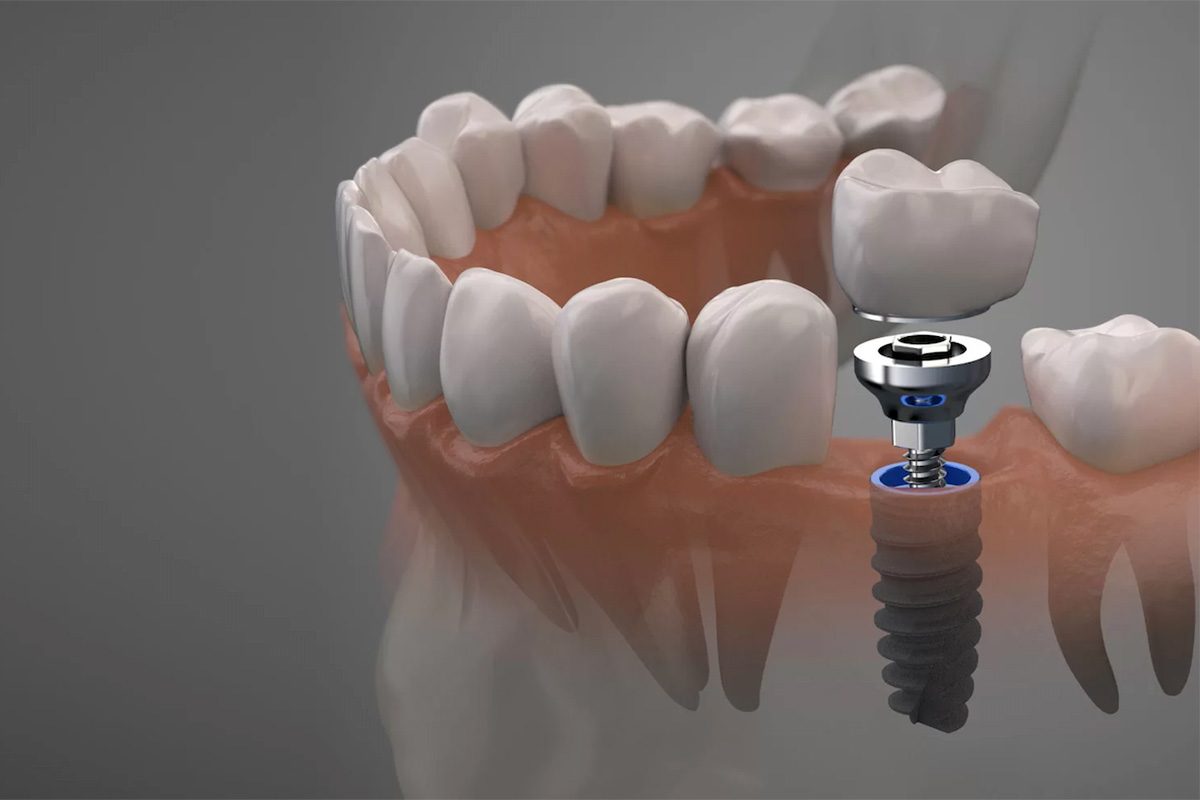 Dental Implants Affordable Cosmetic Dentistry Services in Thornhill, Ontario
