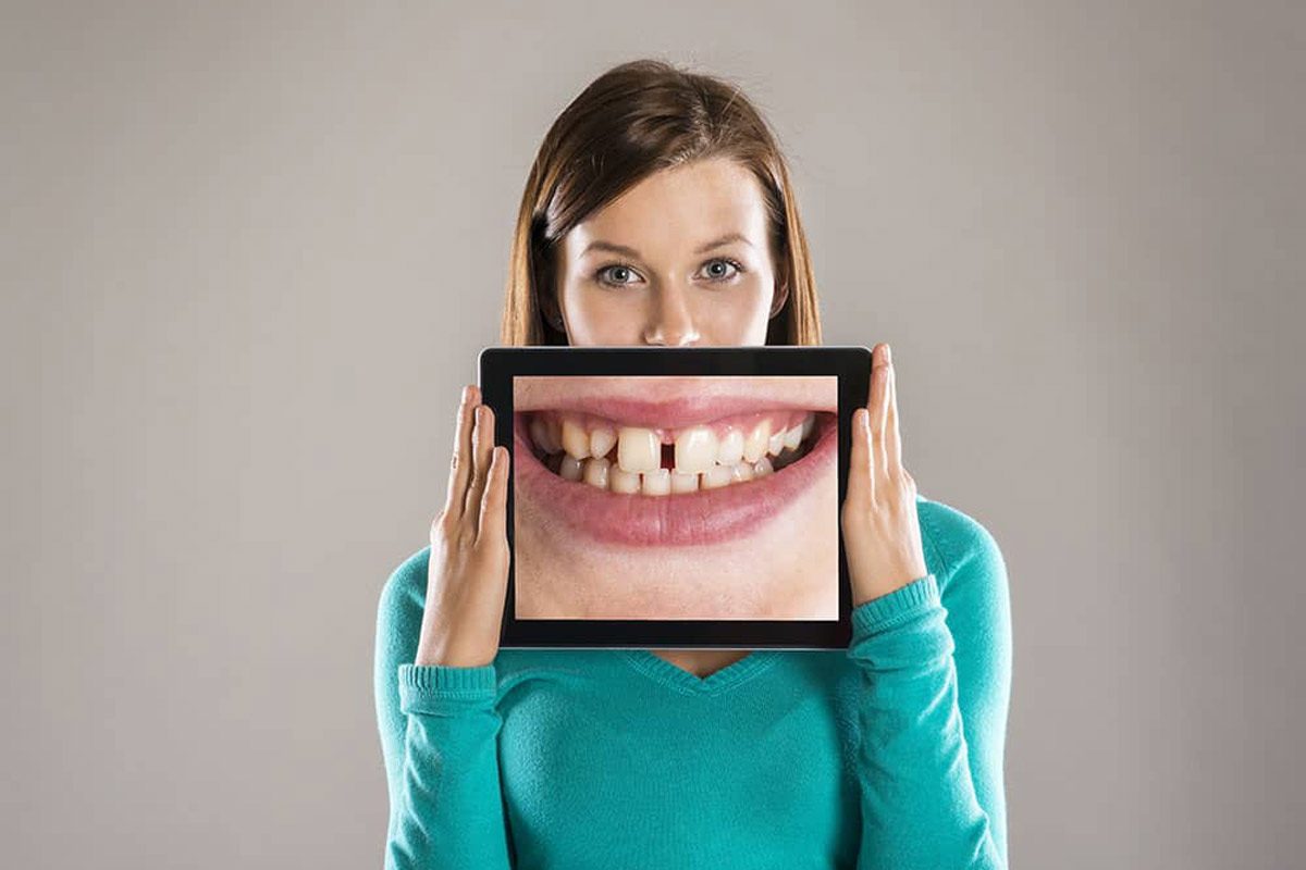 Dental Veneers Addressing Dental Imperfections