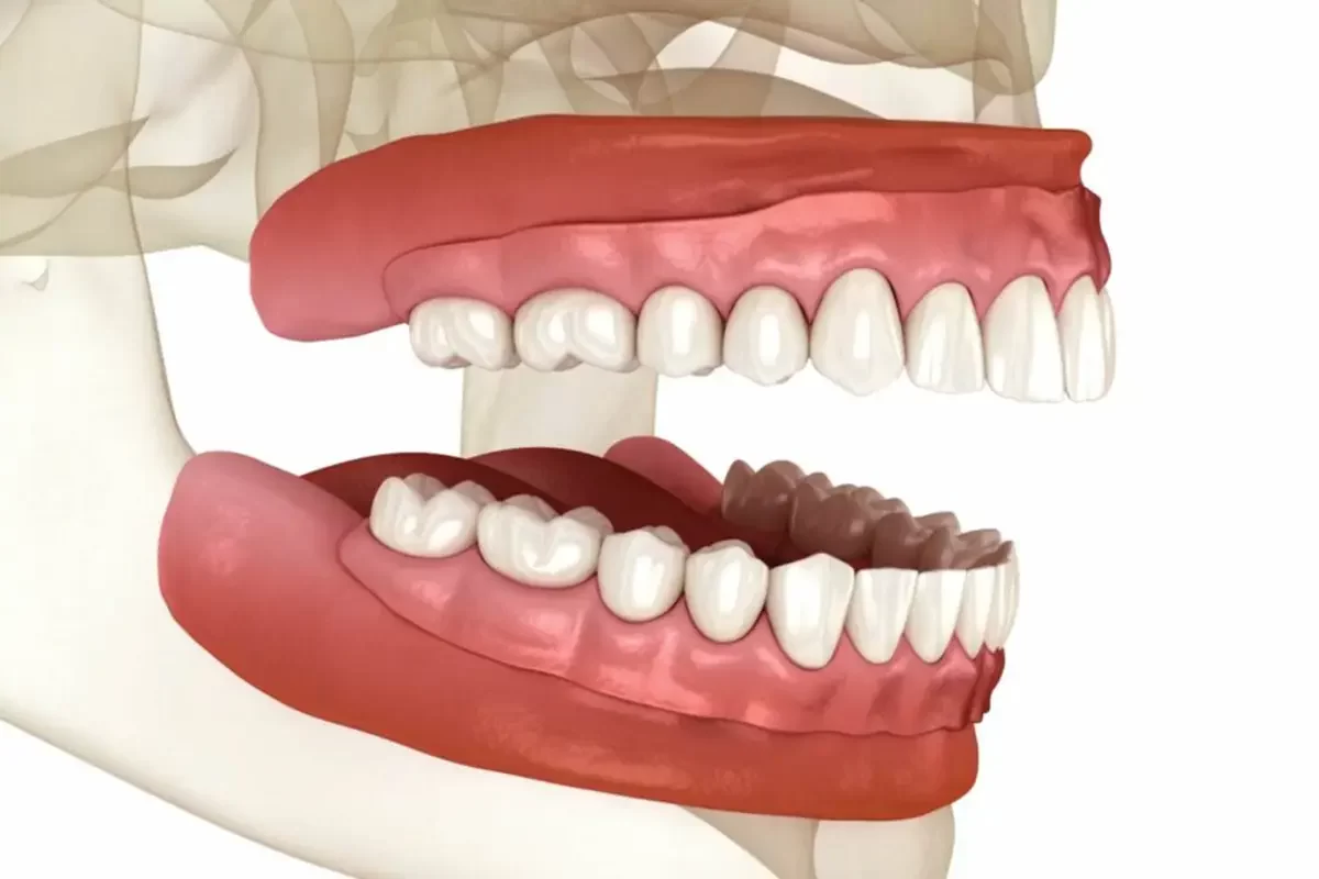 Identifying Indicators of Tooth Loss and the Significance of Dentures
