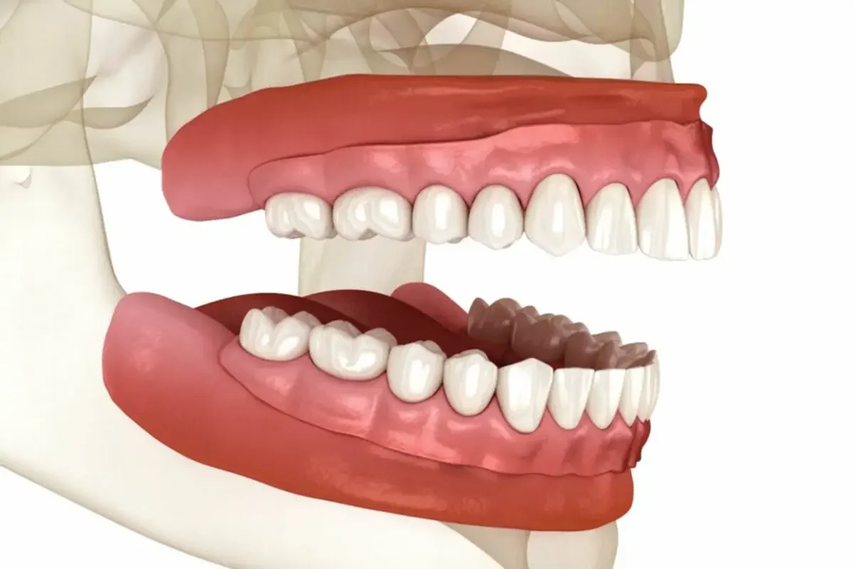 Dentures Identifying Indicators of Tooth Loss and the Significance of Dentures