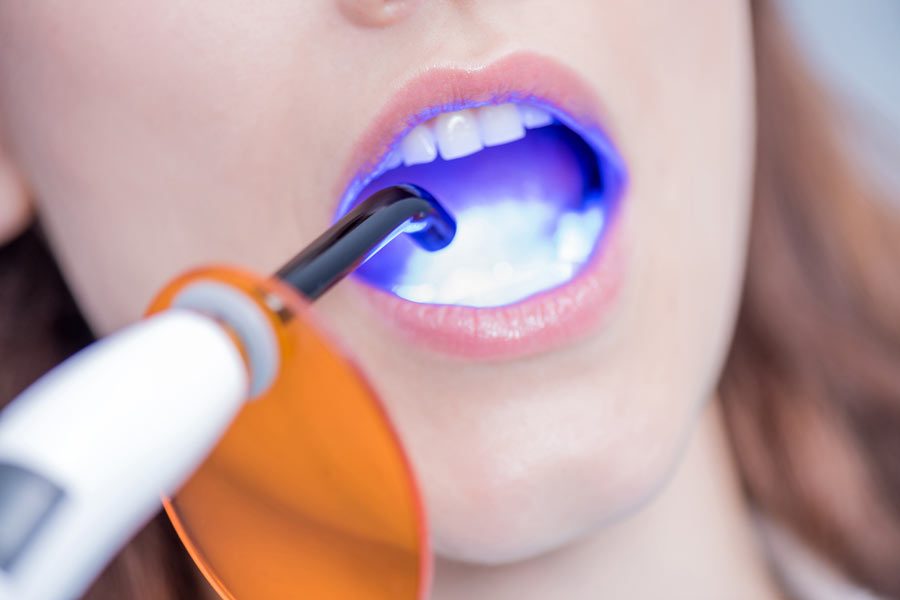 Tooth-Whitening