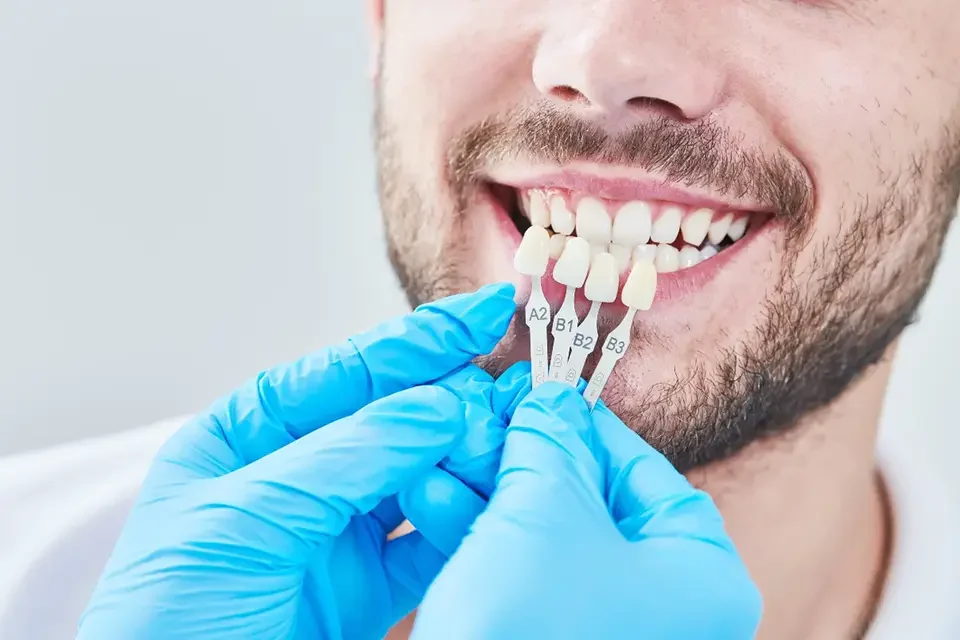 Veneers Dental Bonding Vs. Veneers: Choosing the Right Option for You